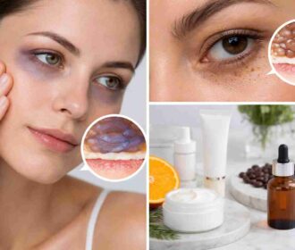علت تیرگی دور چشم چیست؟ بررسی علمی + روش درمان مؤثر